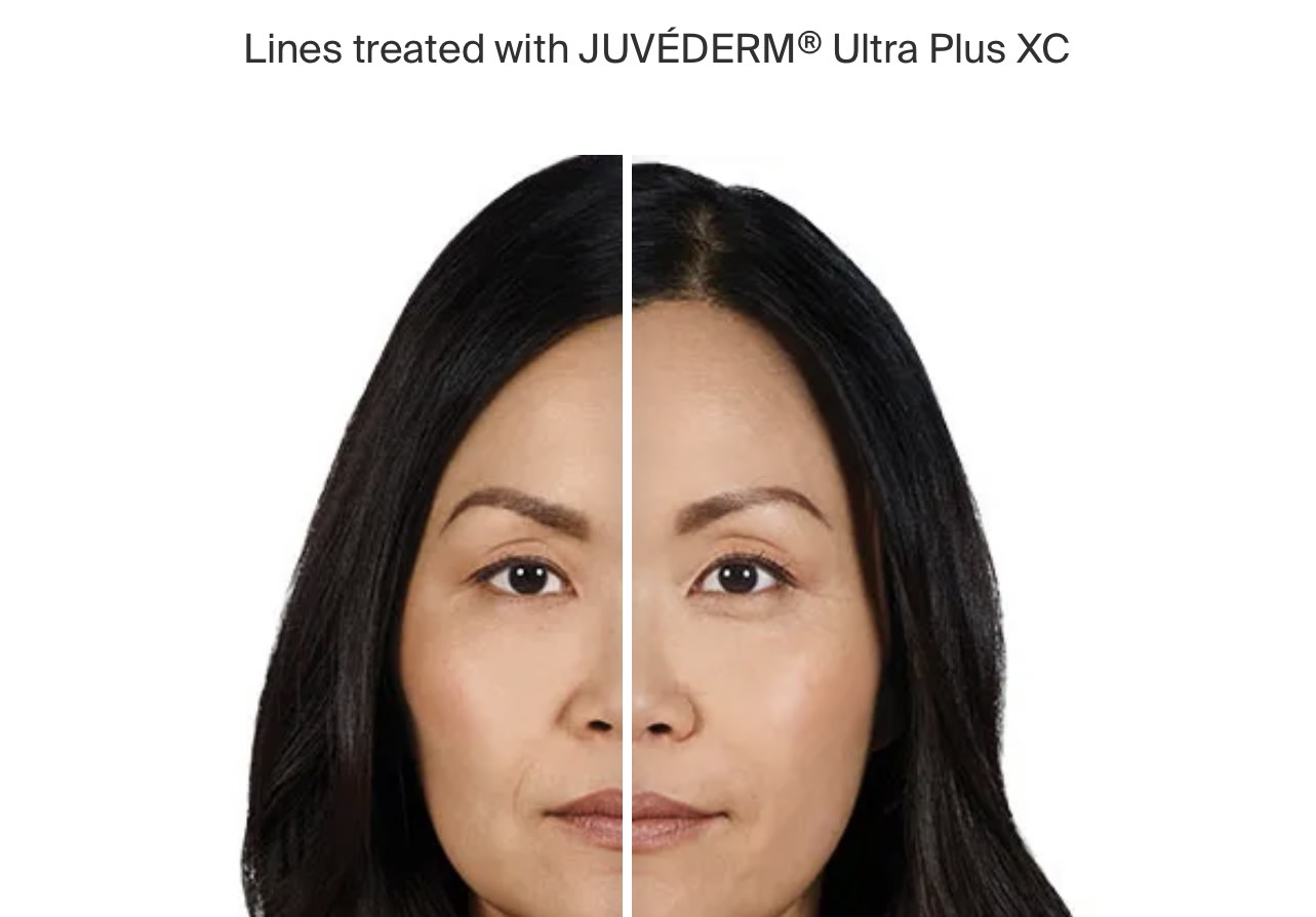 Juvederm Before-After photo