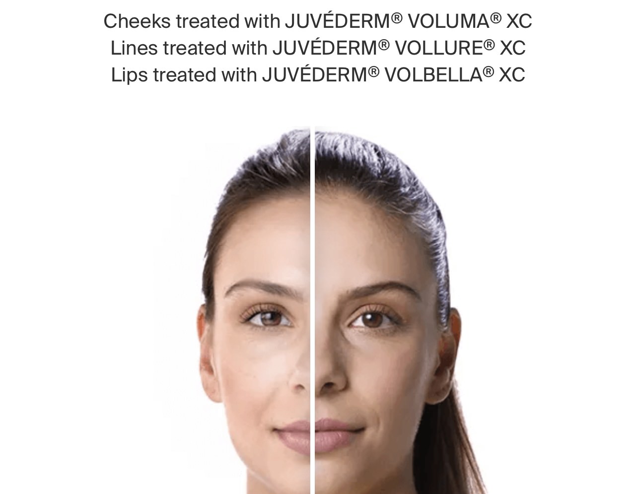 Juvederm Before-After photo